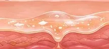 Ilustração do peeling sobre a camada superficial da pele.