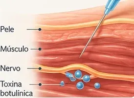 Ilustração das camadas de pele, músculo e nervo, com a agulha aplicando a toxina no músculo.