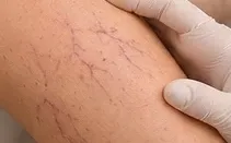 Mão de luva avaliando vasinhos na perna.