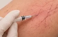 Agulha fina aplicando a solução em um vasinho.
