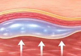 Ilustração da camada de gel dando sustentação à pele.