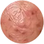 Acneica