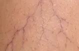 Vasinhos finos