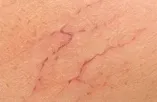 Vasinhos superficiais