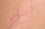 Vasinhos em teia